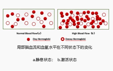 fNIRS研究表明：有/无自杀意念的抑郁症个体在特定任务期间DLPFC激活不同