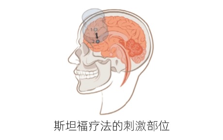 高质量文献：多疗程斯坦福疗法（SNT）对重度抑郁症复发后疗效验证